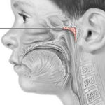 Hipertrofia de adenoide