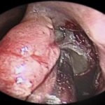 Cirurgia para sinusite crônica