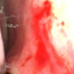 Sangramento nasal anterior área de little